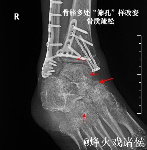 加福德：右脚踝感觉好多了，这是长时间以来感觉最好的一次